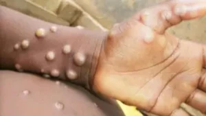 who-confirms-mpox-is-not-the-new-covid-19-effective-control-measures-in-place-Kuwait-2024-08-20-17-26-26.webp