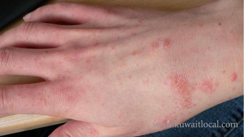 270-cases-of-scabies-have-been-recorded-in-the-country-_kuwait