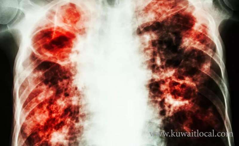 diagnosed-with-tb-in-past-now-cured--can-i-apply-for-job-in-kuwait_kuwait