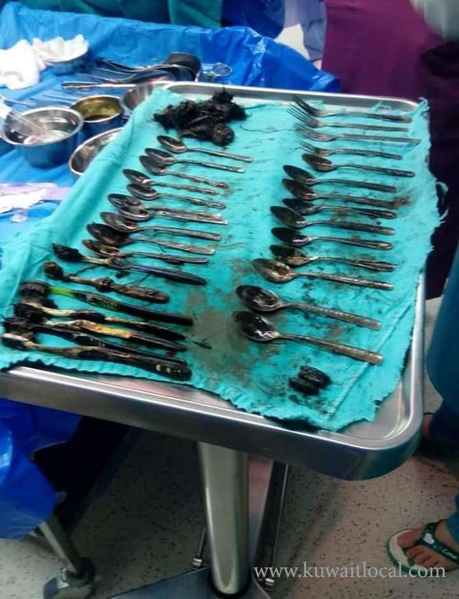 egyptian-surgeons-recover-20-spoons-from-patients-stomach_kuwait