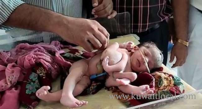 baby-born-with-4-legs-and-3-hands-in-india_kuwait