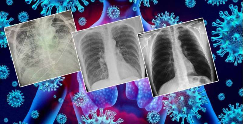 xrays-show-that-the-lung-of-a-person-with-corona-becomes-worse-than-the-lung-of-smokers_kuwait