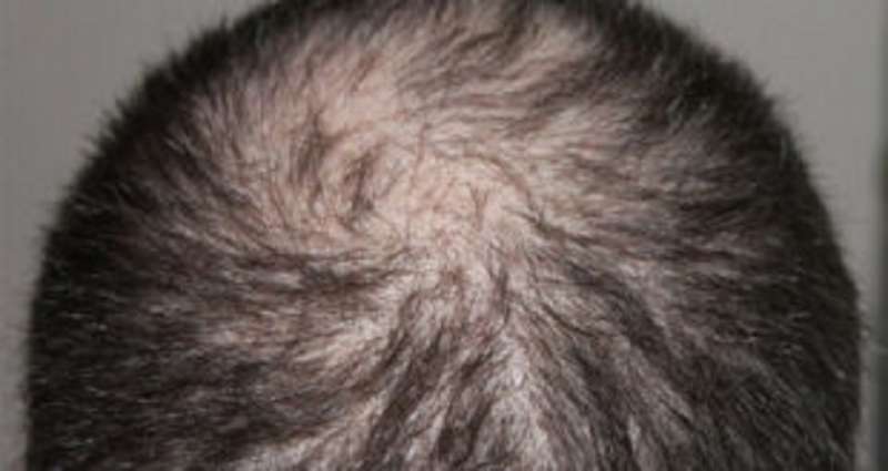 hair-loss-common-symptom-after-covid19-infection_kuwait