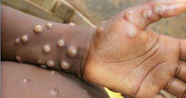 monkeypox-outbreak-in-europe-largest-in-area-as-cases-cross-100_kuwait